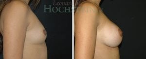 Breast Augmentation Patient