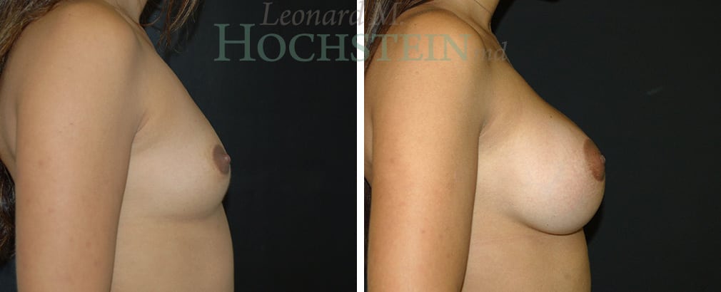Breast Augmentation Patient