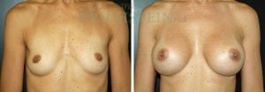 Breast Augmentation Patient