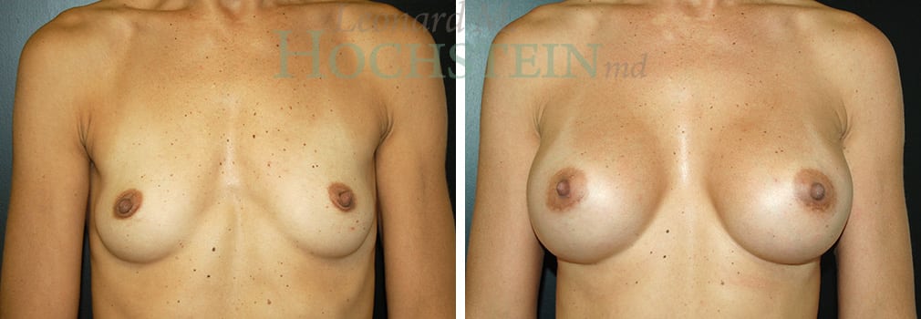 Breast Augmentation Patient