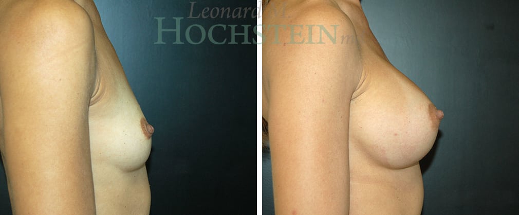 Breast Augmentation Patient