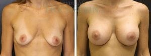 Breast Augmentation Patient