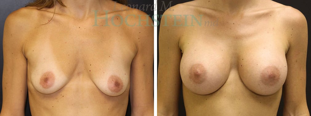 Breast Augmentation Patient