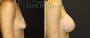 Breast Augmentation Patient