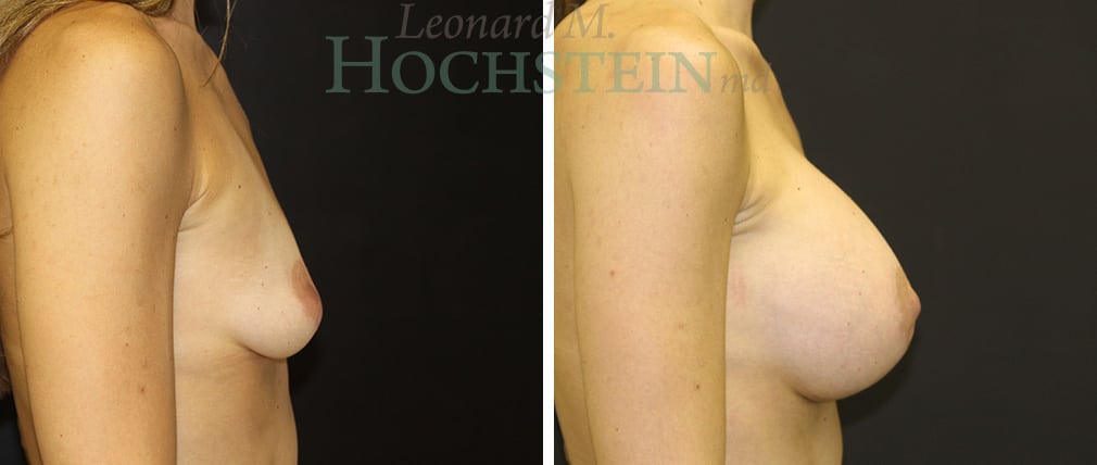 Breast Augmentation Patient