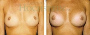 Breast Augmentation Patient
