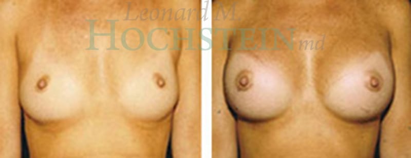 Breast Augmentation Patient