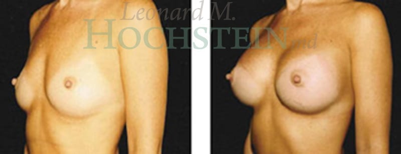 Breast Augmentation Patient