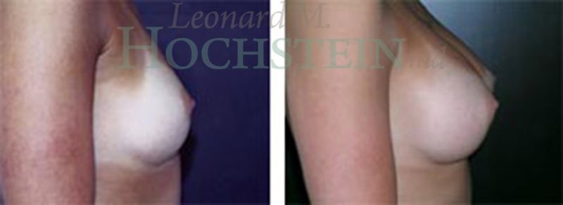 Breast Augmentation Patient