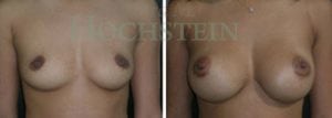 Breast Augmentation Patient
