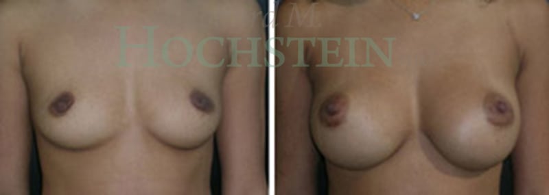 Breast Augmentation Patient