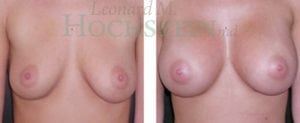 Breast Augmentation Patient