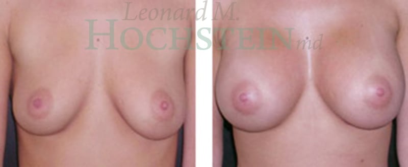 Breast Augmentation Patient