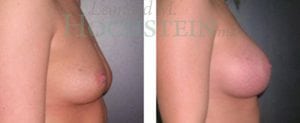 Breast Augmentation Patient
