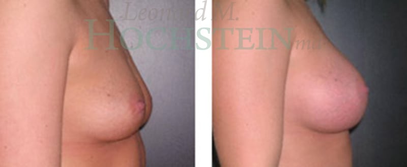 Breast Augmentation Patient
