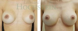 Breast Augmentation Patient