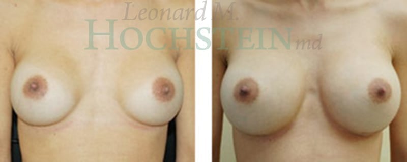 Breast Augmentation Patient