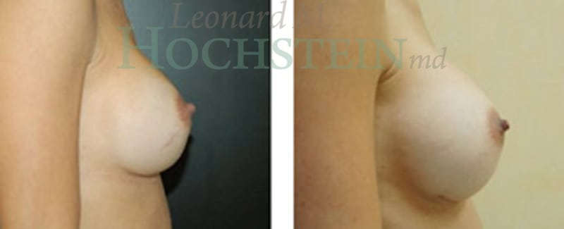 Breast Augmentation Patient