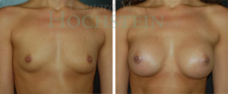 Breast Augmentation Patient