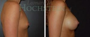 Breast Augmentation Patient