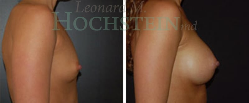 Breast Augmentation Patient