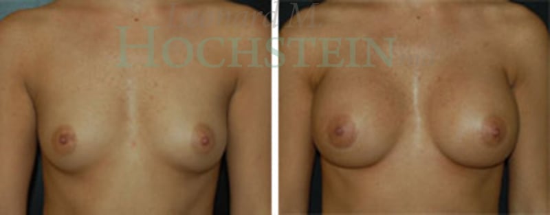 Breast Augmentation Patient