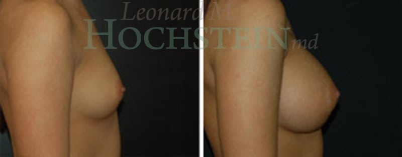 Breast Augmentation Patient