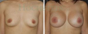 Breast Augmentation Patient