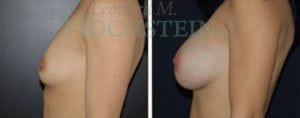 Breast Augmentation Patient