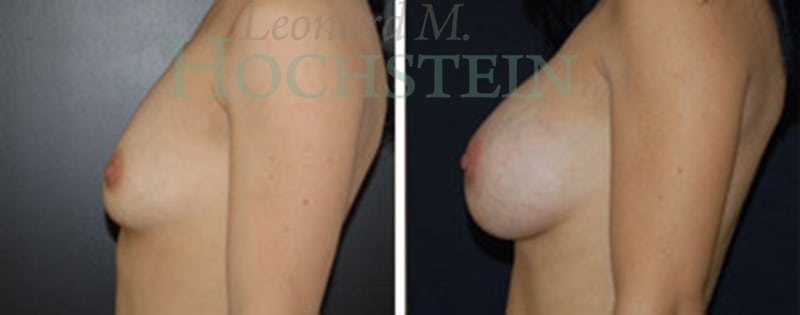Breast Augmentation Patient