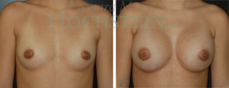 Breast Augmentation Patient