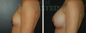 Breast Augmentation Patient