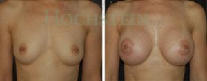 Breast Augmentation Patient