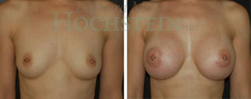 Breast Augmentation Patient