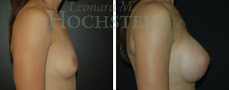 Breast Augmentation Patient