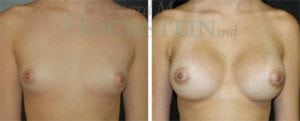 Breast Augmentation Patient