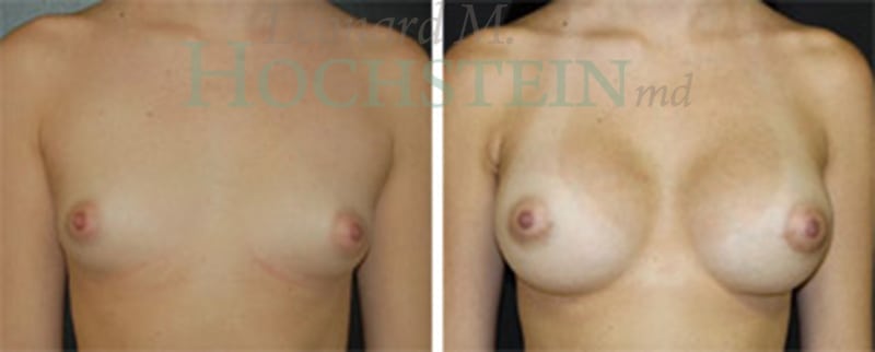 Breast Augmentation Patient