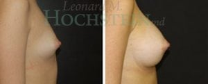 Breast Augmentation Patient