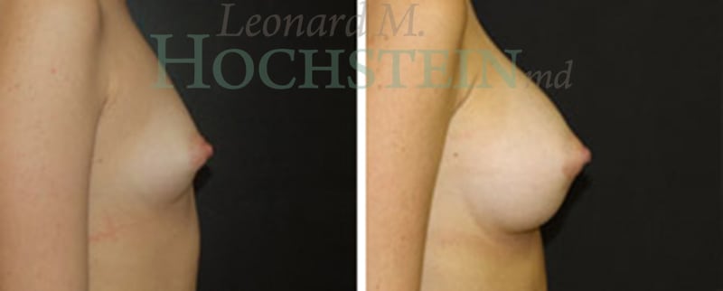 Breast Augmentation Patient