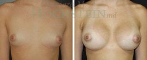 Breast Augmentation Patient 101