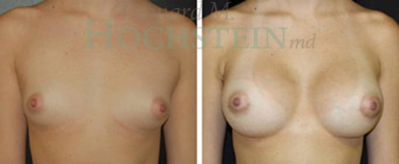 Breast Augmentation Patient