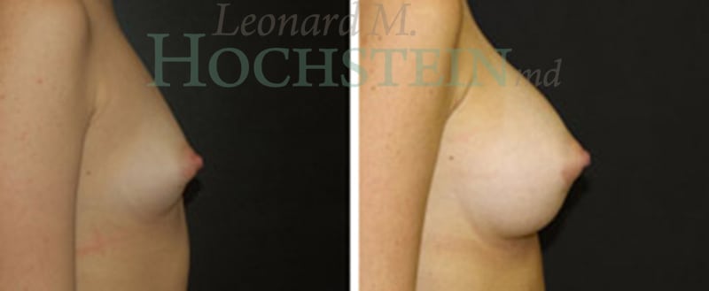 Breast Augmentation Patient