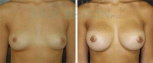 Breast Augmentation Patient