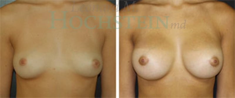 Breast Augmentation Patient