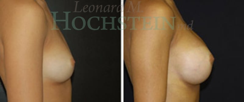 Breast Augmentation Patient