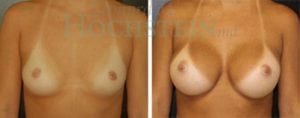 Breast Augmentation Patient