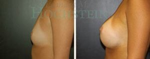 Breast Augmentation Patient