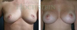 Breast Augmentation Patient