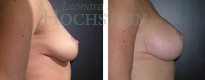 Breast Augmentation Patient
