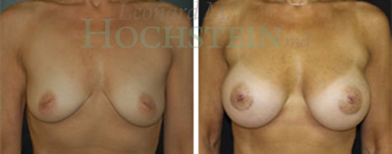 Breast Augmentation Patient